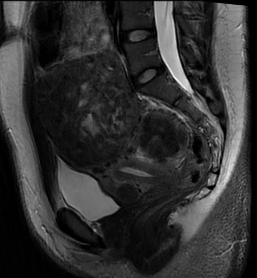 Long case example 2